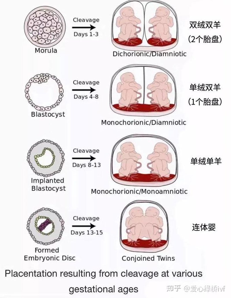 试管双胞胎